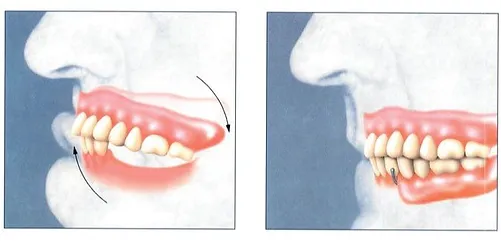 denture implant